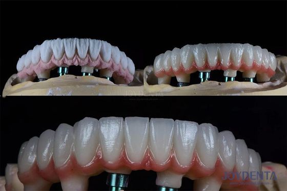 주문 10mm 다발 치아 2단계 치아 임플란트 키트 온라인 제품