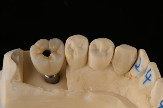 주문 3.75mm 실버 티타늄 나사 치아 임플란트 단일 치아 교체 임플란트 온라인 제품