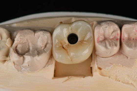 주문 티타늄 10mm 단일 치아 치아 임플란트 교체 부트먼트 자기 탭 샌드 블래스팅 온라인 제품