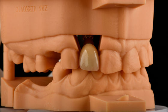 주문 내부 헥스 3.0mm 깊이 1.5mm 피치 단일 티타늄 치아 임플란트 교체 온라인 제품