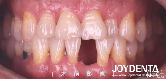 주문 맞춤형 치아 메릴랜드 樹脂 결합 다리 앞과 앞 치아 온라인 제품