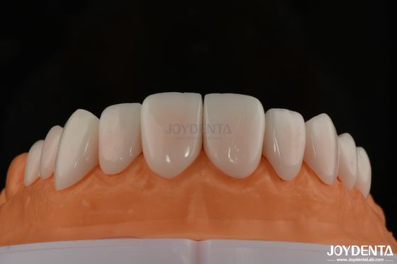 주문 A1-A4 Ips Emax 프레스 포르셀린 치아 장단 스탠 저항성 사용자 정의 가능한 모양 온라인 제품
