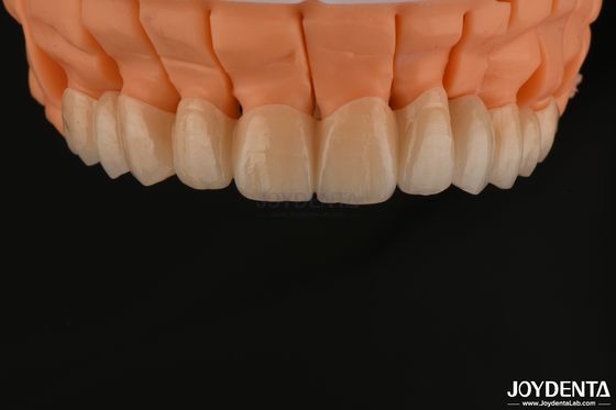 주문 높은 미적 지층 지르코니아 단일 왕관 다리 치아 복원을 위한 임플란트 온라인 제품