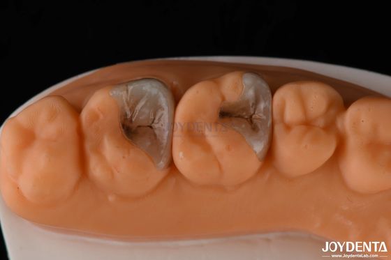 주문 치아 복원을 위한 복합 인레이 및 온레이 치아 구조에 강한 결합 온라인 제품