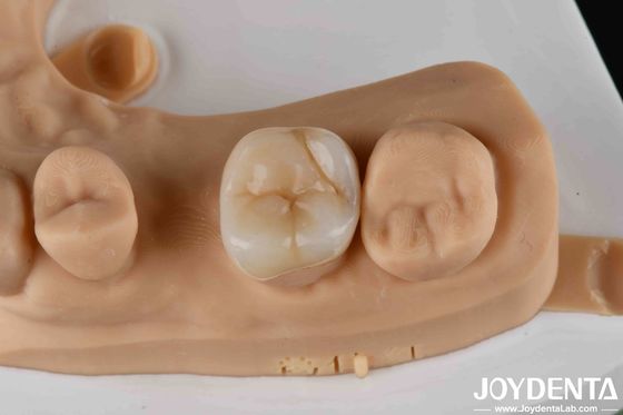 주문 치아 복구를 위한 고강도 Zirconia 치아 인레이 및 온레이 온라인 제품