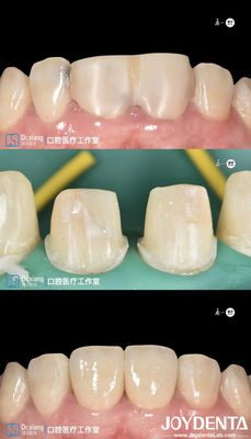 주문 완벽하게 맞는 치아 지르코니아 치아 왕관 온라인 제품