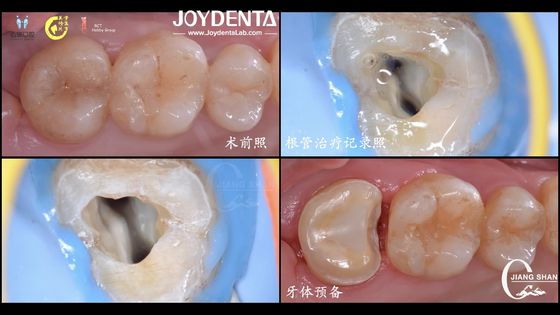 주문 오래 지속되는 자연스러운 외모의 치아 세라믹 인레이 정밀 적합성 높은 호환성 온라인 제품