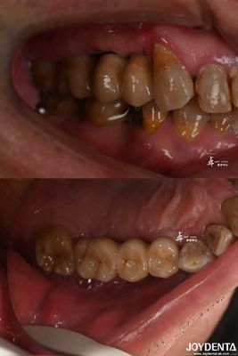 주문 부지런한 표면 디자인 치아 임플란트 온라인 제품