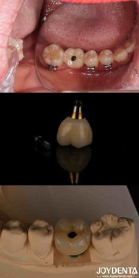 주문 4-6 치아 내골형 톱니형 임플란트 온라인 제품