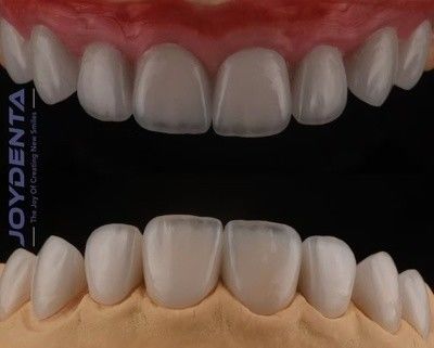 주문 높은 투명성 Feldspathic 장단, 강한 접착력을 가진 화장품 포르셀린 장단 온라인 제품