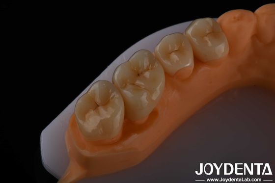 주문 높은 미학 전체 윤곽 왕관을위한 Zirconia 다리 임플란트 치아 복원 온라인 제품