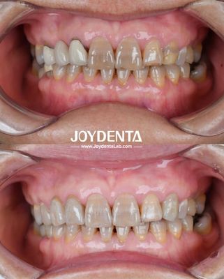 주문 가벼운 치아 지르코니아 최적의 환자 경험을 위해 자연 색상 전환과 생물 호환성 보장 온라인 제품