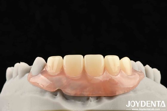 주문 기술 프레임 워크를 개발하여 치아 기술에서 안정적인 구강 구조를 위해 치아 마무리 설정 온라인 제품
