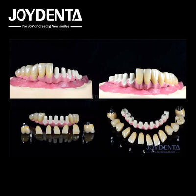 주문 다중 내골 치아 임플란트 전체 아치 복원을 위한 내부 연결 온라인 제품