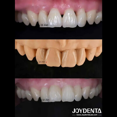 주문 풀벌레 장단 천연 투명 치아 장단 에 대한 완벽한 해결책 온라인 제품