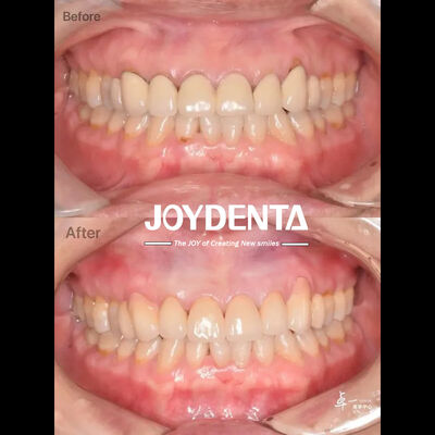 주문 안전한 구강 조직을 위한 치과용 지르코니아 및 CAD/CAM 호환성 온라인 제품
