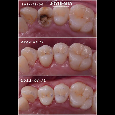 주문 정확 한 치아 포스텔라인 인플레이어 손상 된 치아 복원 성인 및 어린이 온라인 제품