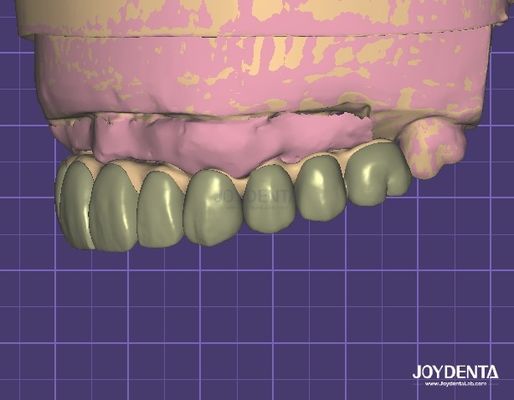 HIPAA를 준수하는 데이터 보안 치과 수정을위한 디지털 Wax Up 3D 모델