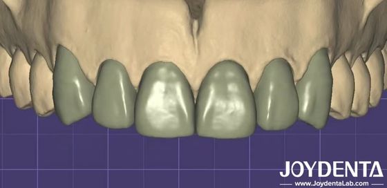 3D 프린팅 가상 디지털 백스 업 다른 치과 소프트웨어와 원활한 호환성