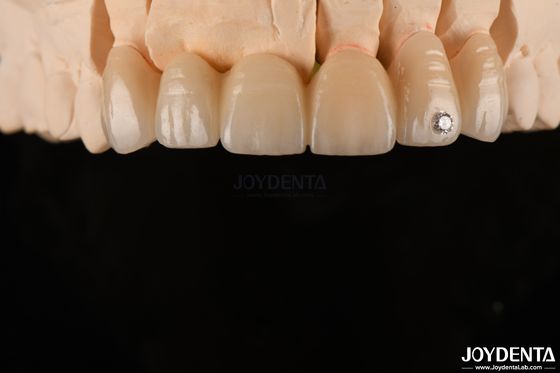 CAD / CAM 프레싱 치아 단층 Zirconia 단일 왕관을 위해 0.3-0.5mm 층 두께