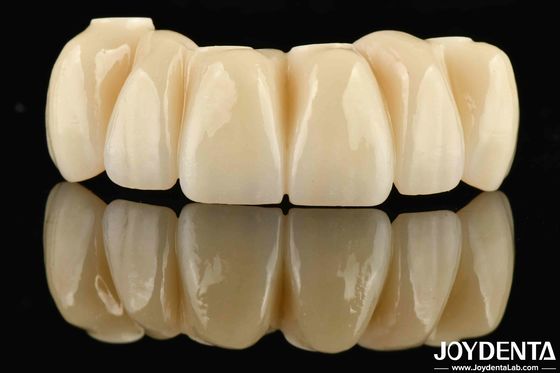 치아 복원 Ti-Base Zirconia 하이브리드 브릿지 자연스러운 모양 정밀한 적합성