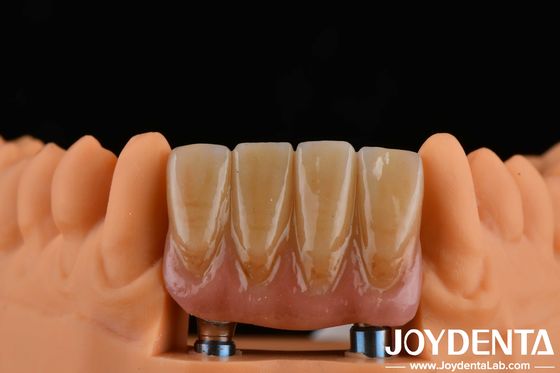 4.5mm 높이 완성된 아부트먼트 내부 헥스 연결 유형 임플란트 시스템과 호환