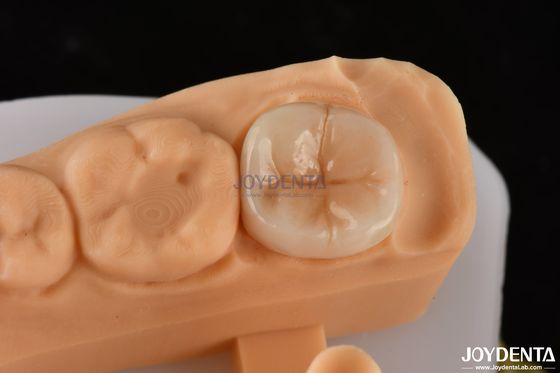 0.5mm-2mm 정밀 맞춤식 Emax 치아 인레이