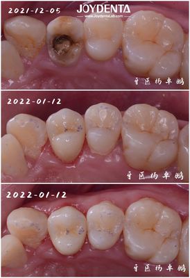 정확 한 치아 포스텔라인 인플레이어 손상 된 치아 복원 성인 및 어린이