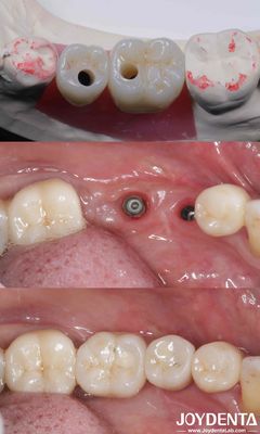실린더형 모든 4 티타늄 치아 임플란트 10-16mm 길이 헥스 연결