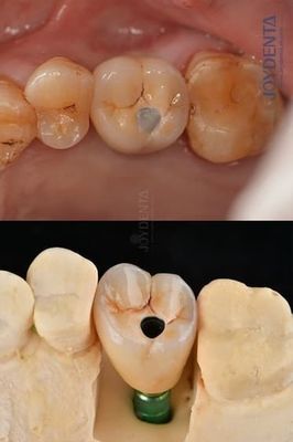 티타늄 풀 아치 치아 임플란트 외형 플랫폼 4.1mm