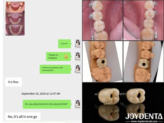 장기간 지속되는 전체 아치 치아 임플란트 내골 임플란트 길이 10mm-16mm