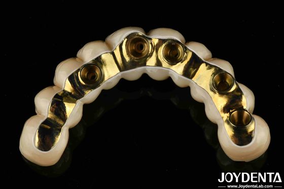 맞춤 제작 Ti-Bar Zirconia 하이브리드 브리지 정밀 맞춤형 치아 의족