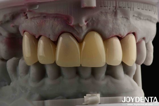 CAD CAM 처리 치과 PMMA 재료 자연 그림자 전환을 위한 다층 디자인