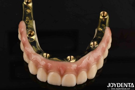 치아 인공치료 고도의 생물 호환성 기준으로 Ti-Bar Zirconia 하이브리드 브리지