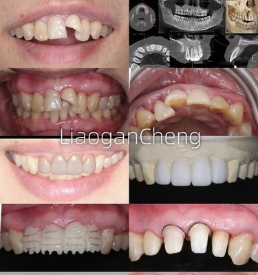 생물 호환성 장기 및 임플란트 지원 복원을 위한 안전한 지르코니아 치아 왕관