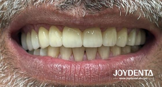 자연 치아 를 흉내내는 지르코니아 치아