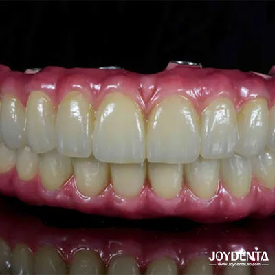 가벼운 치아 티타늄 말롱 하이브리드 브리지 치아 복원을 위해 편안