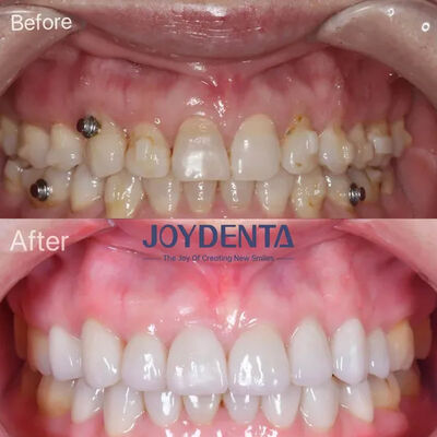 빠진 치아를 위한 치아 장단