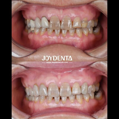 가벼운 치아 지르코니아