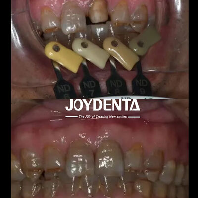 반투명 지르코니아 크라운 다층 그라데이션 기술