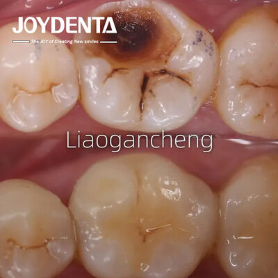 성인과 어린이용 포르셀린 치아 인레이 복원