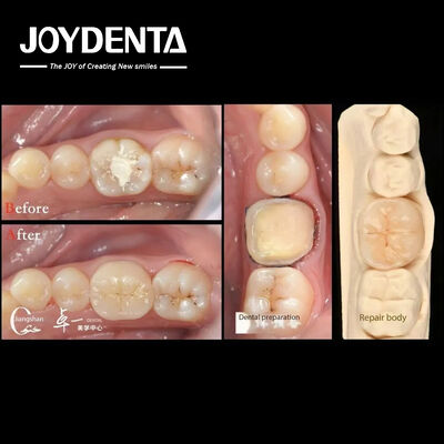 생체 적합성 및 자연 치아 복원과의 높은 호환성