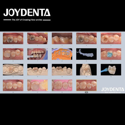 성인 어린이 포르셀라인 세라믹 치아 인레이 손상된 치아에 대한 복원